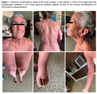 Chromoanagenesis and erythroderma